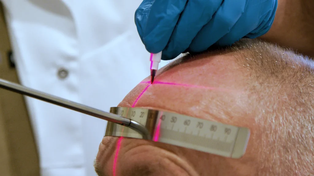 Close-up van het meten van de voorhoofd bij een DHI-haarextractie behandeling bij Armeda Clinics in Eindhoven