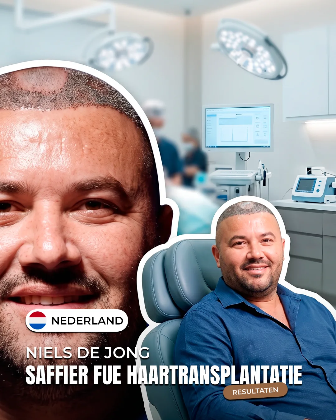 Niels de Jong — Saffier FUE haartransplantatie