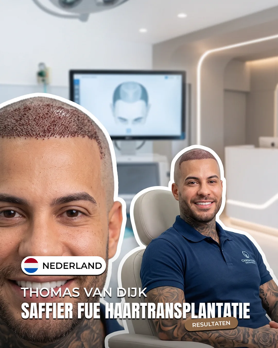 Thomas van Dijk — Saffier FUE haartransplantatie