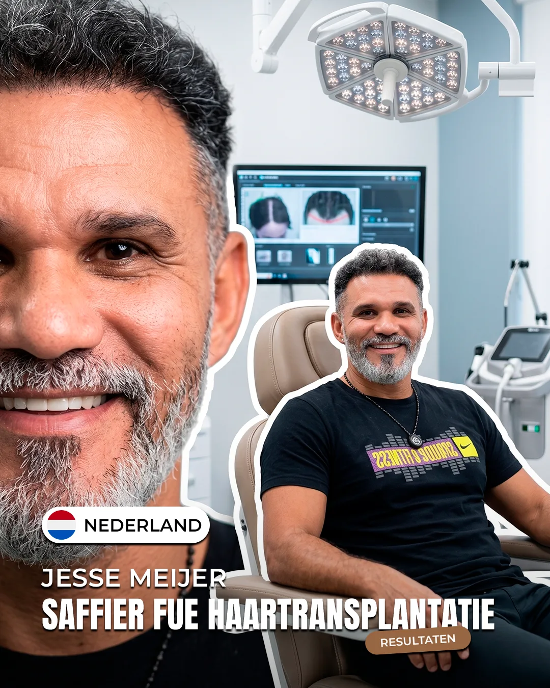 Jesse Meijer — Saffier FUE haartransplantatie