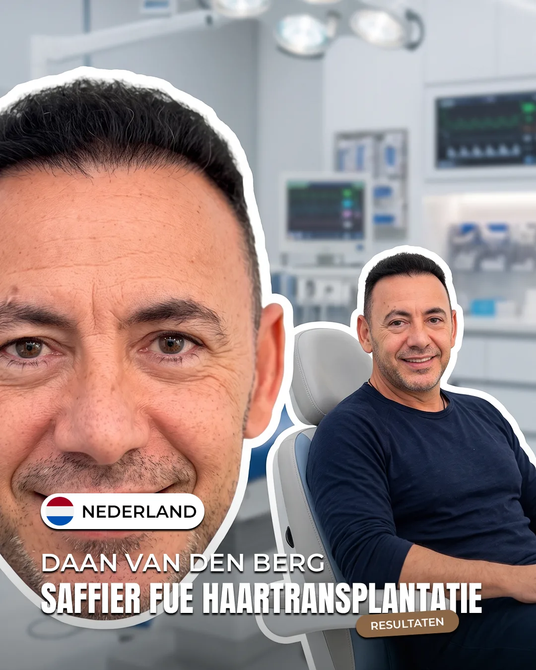 Daan van den Berg — Saffier FUE haartransplantatie