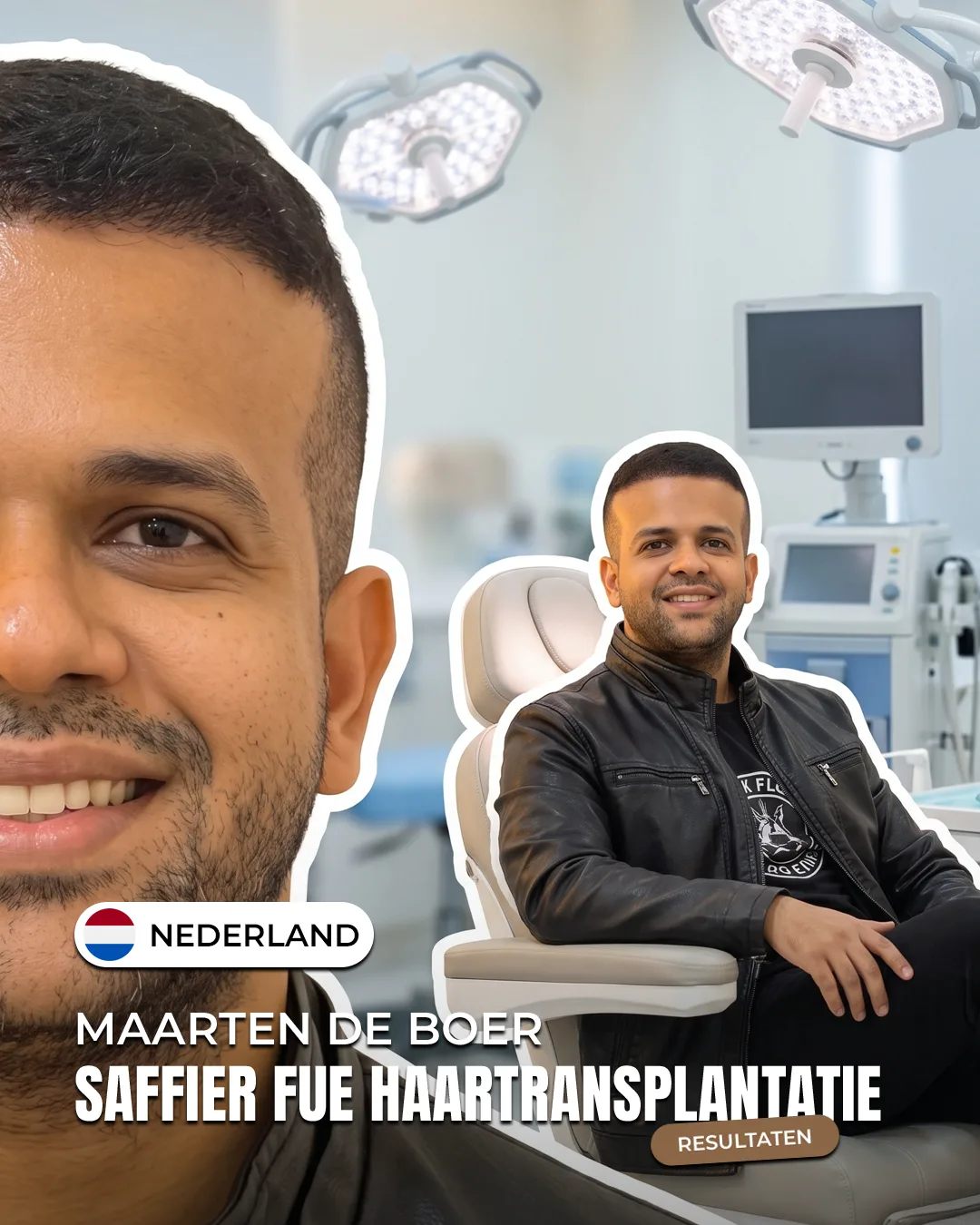 Maarten de Boer — Saffier FUE haartransplantatie