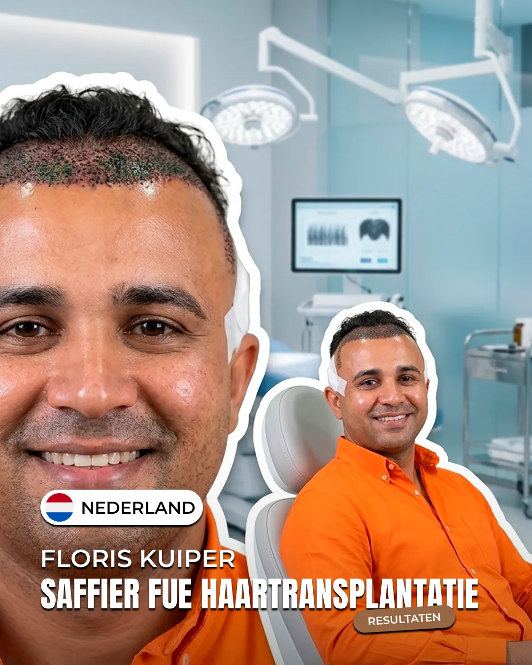 Floris Kuiper — Saffier FUE haartransplantatie